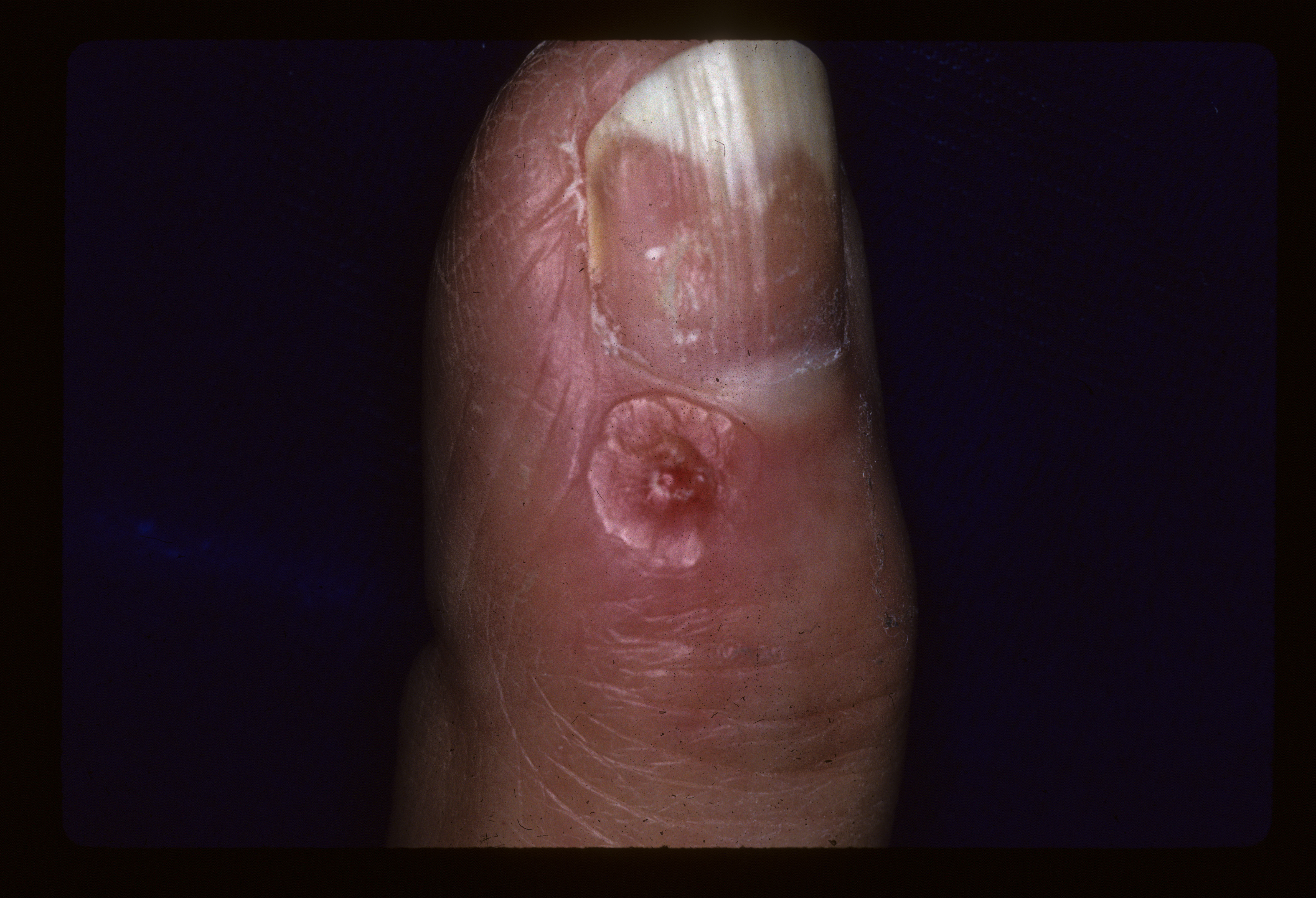 Digital Mucous Cyst Icd 10 digitalpictures